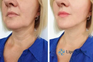 Double chin before and after Hi-Fu treatment 4 Book your double chin treatment Beccles today! We are here to help!