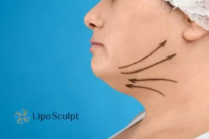 Double chin before and after Hi-Fu treatment 3 Boost your confidence with a Double chin treatment Beccles