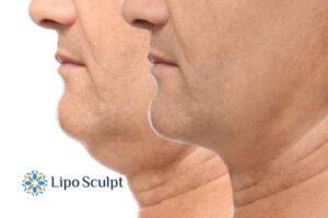 Double chin before and after Hi-Fu treatment 2 Double chin treatment Beccles from Lipo Sculpt - feel more confident today!