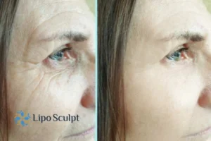 How to Fight Aging Symptoms 2 Do you want to Fight Aging Symptoms Beccles? Contact Lipo Sculpt today!