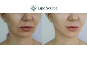 Explaining Total Skin Tightening Treatment And What It Can Do For You 2 Do you want to boost your self confidence? Give Morpheus8 Beccles a try today!