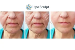 Explaining Total Skin Tightening Treatment And What It Can Do For You 3 Boost your confidence with Morpheus8 Beccles call our team today!