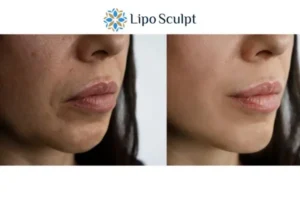 Explaining Total Skin Tightening Treatment And What It Can Do For You 4 Morpheus8 Beccles the best results - call our team today!