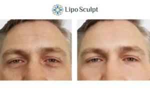 Explaining Total Skin Tightening Treatment And What It Can Do For You 6 Morpheus8 Beccles book in today to find out more!