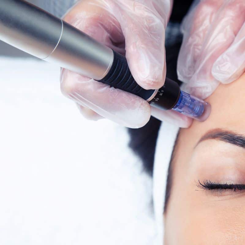Morpheus8 treatment Beccles from Lipo Sculpt - Book in today!